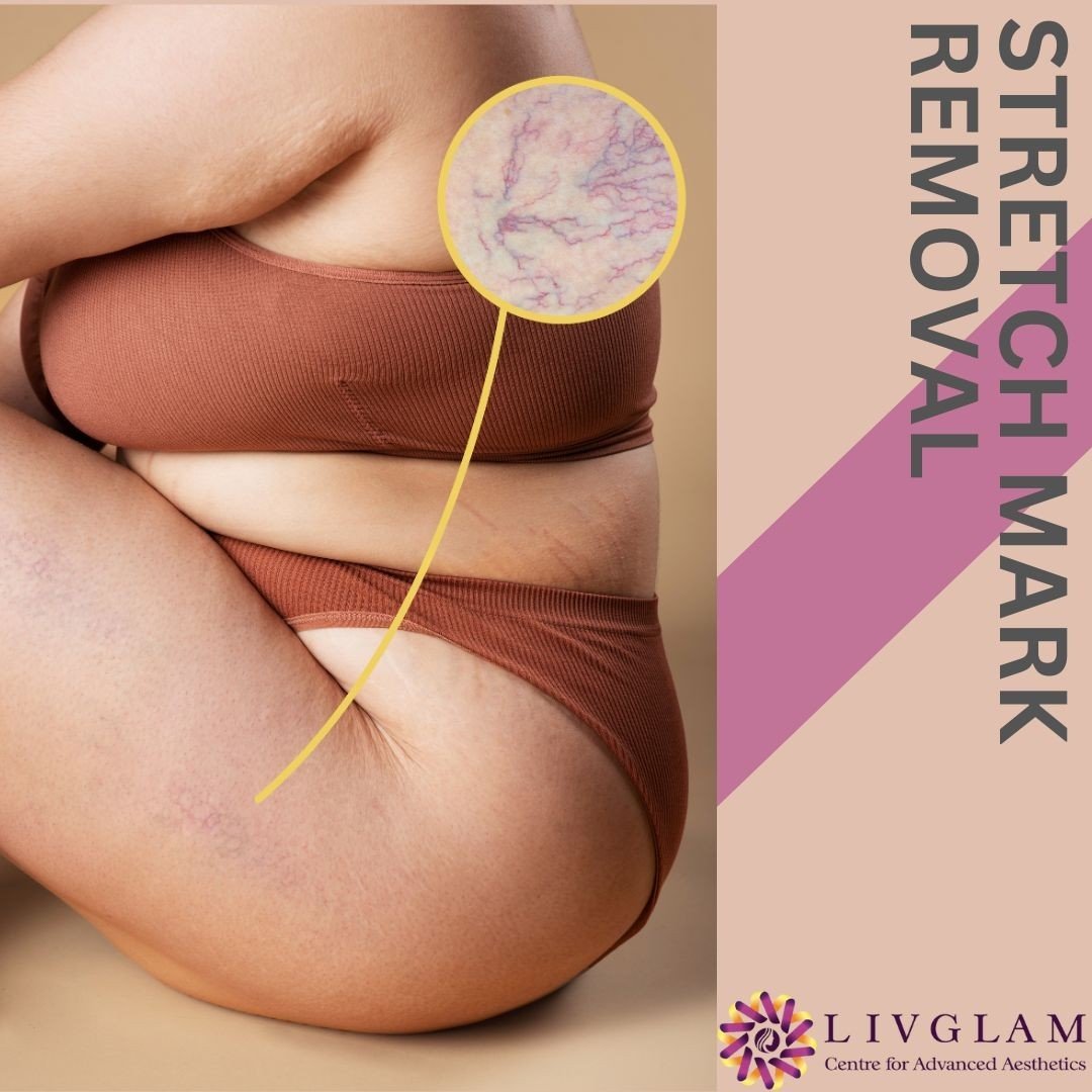 Stretch marks Treatment in Bangalore